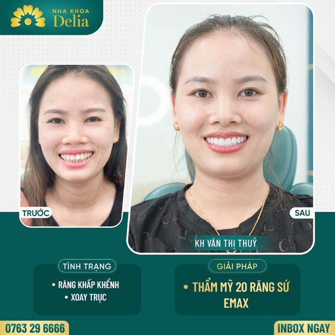 Bọc răng sứ Emax loại bỏ răng khấp khểnh xoay trục – Chị Thủy
