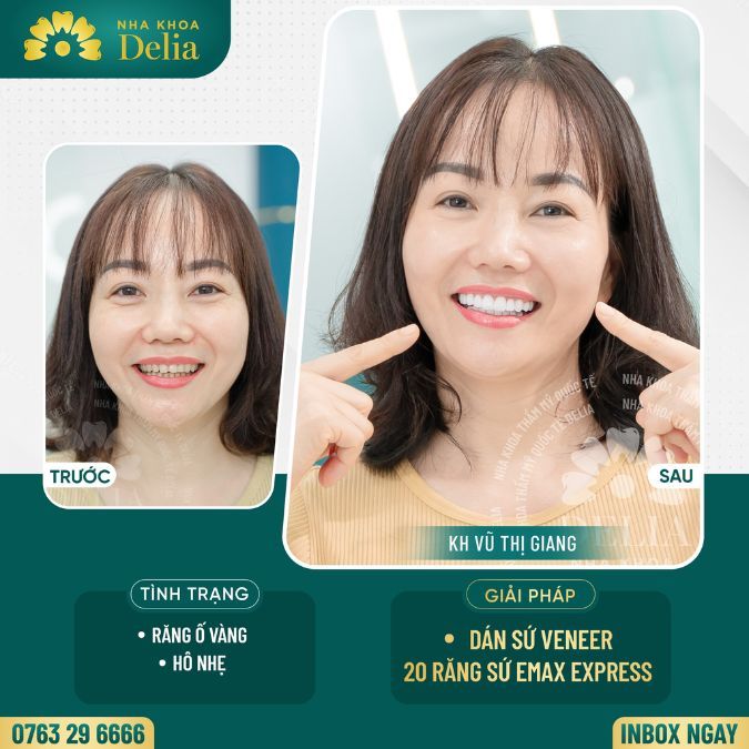 Dán sứ veneer Emax Express tìm nụ cười rạng rỡ cùng chị Giang