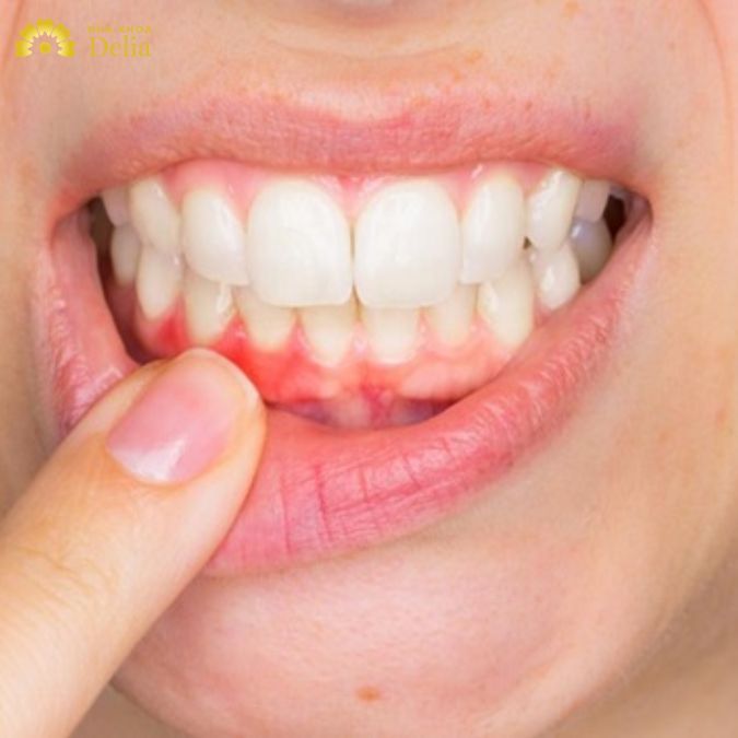 “Thủ phạm” khiến chân răng bị đỏ có thể bạn không ngờ tới
