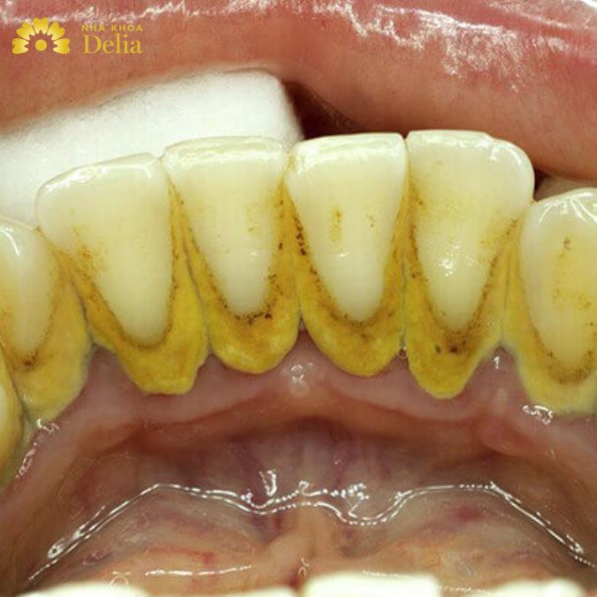 Chân răng bị vôi hóa – 5 Cách cải thiện an toàn nhất ngay tại nhà
