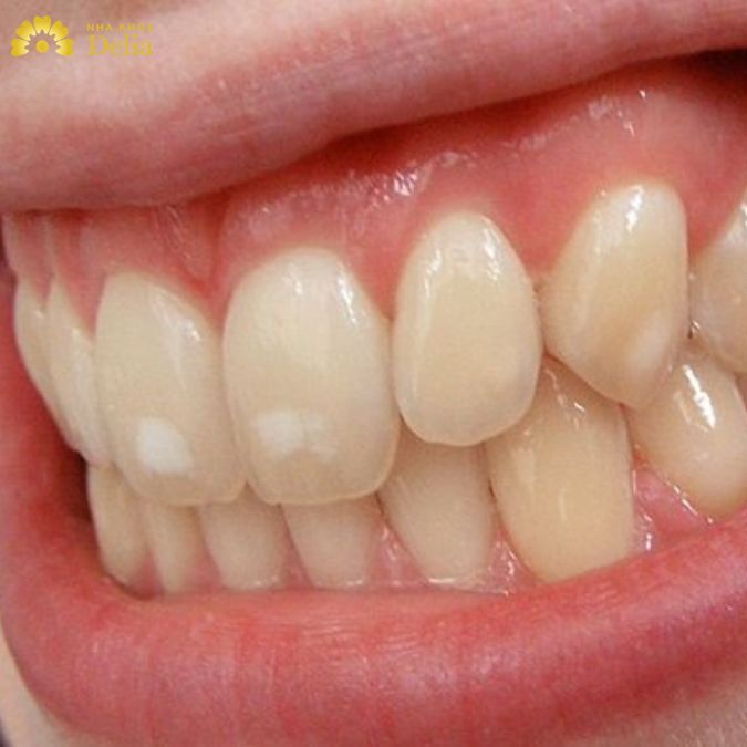 Chân răng có màu trắng cảnh báo bệnh gì? Có nguy hiểm không?