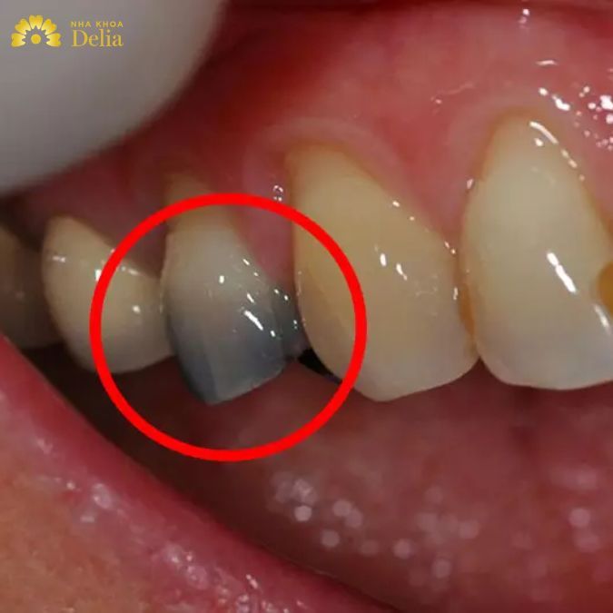 Chân răng có màu xanh nguyên nhân là do đâu? Có nguy hiểm không?