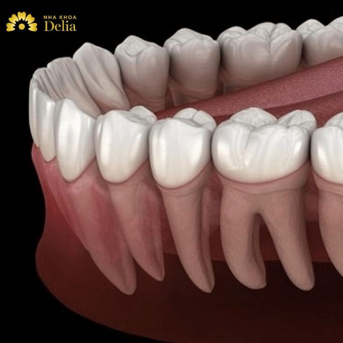 Chân răng dùi trống là gì? Có nên nhổ chân răng dùi trống hay không?