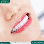 Mức giá dán sứ Veneer không hề rẻ