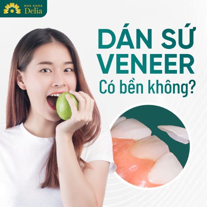 Dán sứ Veneer có bền không? Yếu tố nào ảnh hưởng đến độ bền của dán sứ?