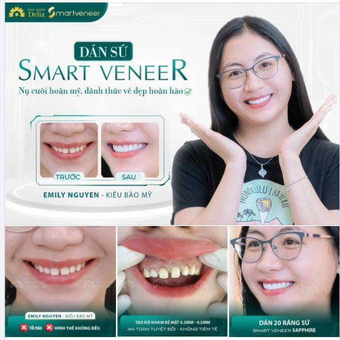 Dán sứ Veneer giá bao nhiêu 1 răng? Đắt hay rẻ? Có nên làm không?