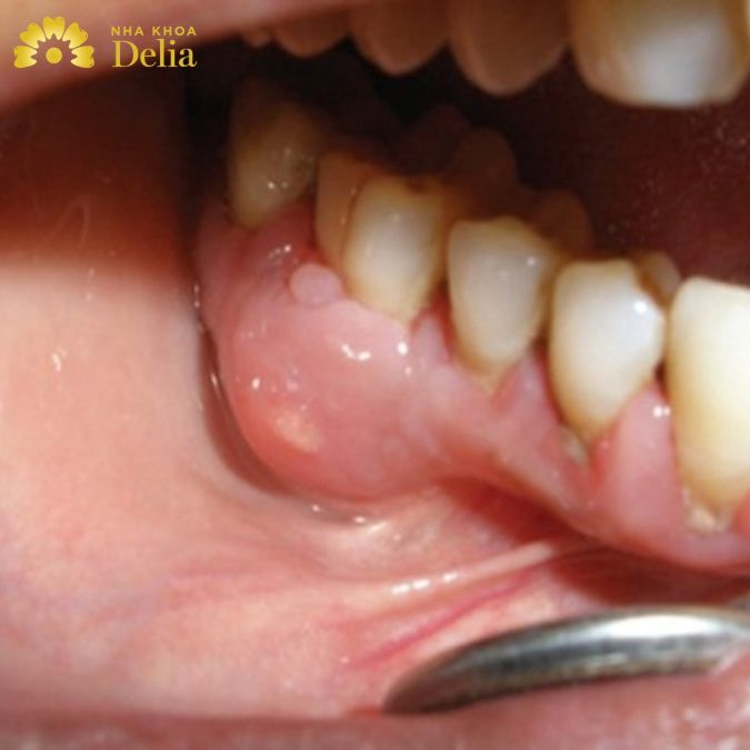 [Cận cảnh] Hình ảnh áp xe răng và 5 triệu chứng thường gặp nhất