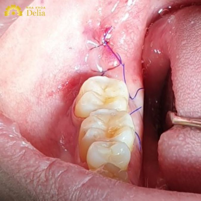 Trọn bộ hình ảnh lợi sau khi nhổ răng giúp bạn hiểu rõ quá trình lành vết thương