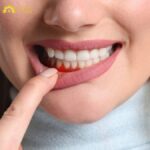 Giai đoạn nặng phát triển thành viêm nha chu