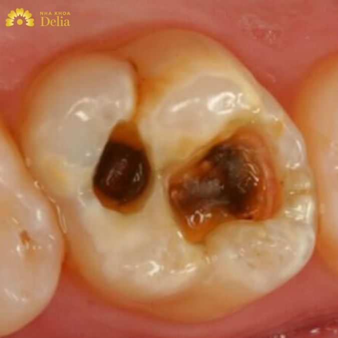 Hình ảnh viêm tủy răng, [Cảnh báo] Viêm tủy răng hoại tử vĩnh viễn