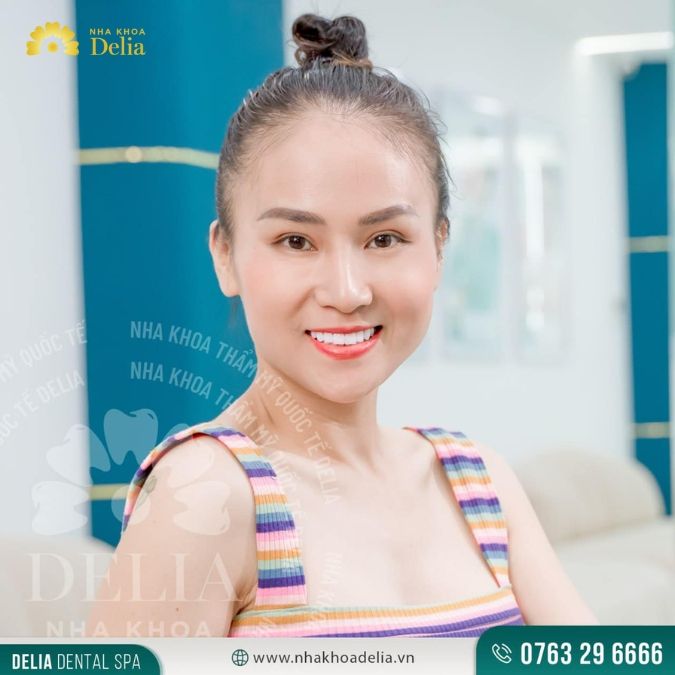 #Câu chuyện khách hàng: Đỗ Vy – Thẩm mỹ 20 răng sứ Nacera