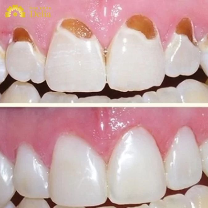 Đâu là “thủ phạm” gây ra tình trạng khuyết cổ chân răng – Giải pháp nào là hoàn hảo nhất?
