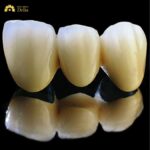 Nên bọc răng sứ kim loại hay titan