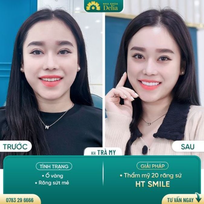 Răng bị mẻ sứt phải làm điều này ngay để phục hình răng tốt nhất