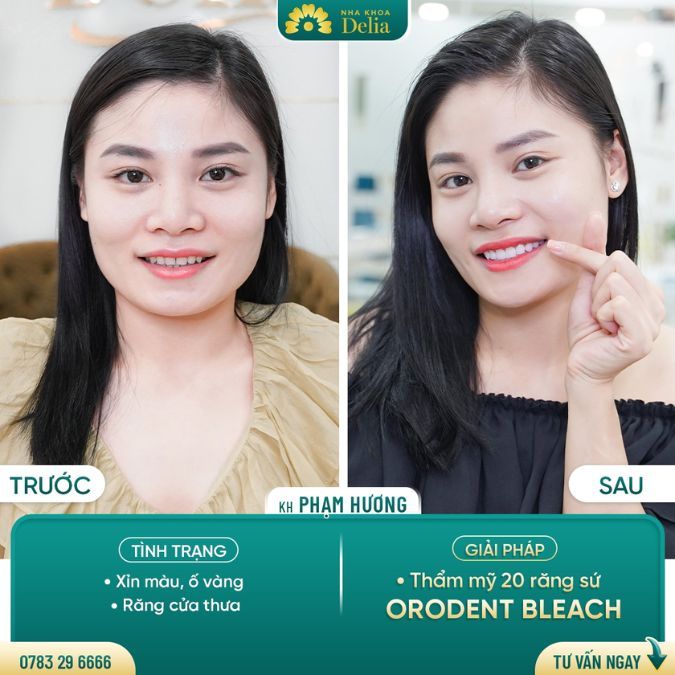 Răng nhiễm Tetracycline: Tẩy trắng, dán sứ Veneer hay bọc sứ?