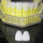 Sứ Sapphire phục hình mão, cầu răng cửa, hàm phủ sứ
