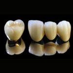 Răng sứ titan giá bao nhiêu