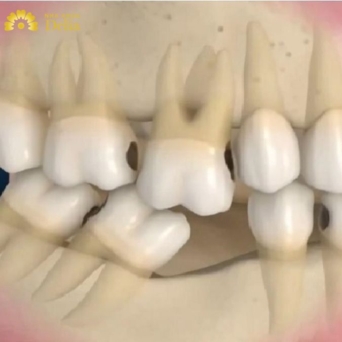 Rỗng chân răng nguyên nhân do đâu? Có thể khắc phục bằng cách nào?