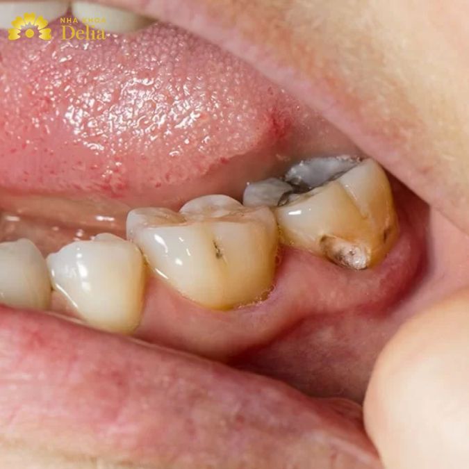 [Tổng hợp] 20+ Hình ảnh sâu răng trẻ em và người lớn mới nhất