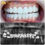 Trồng răng hàm bị sâu