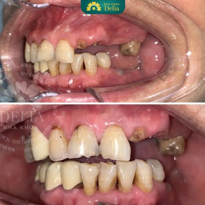 Trồng răng hàm Implant bao nhiêu tiền, có đau không?