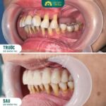 Trồng răng số 7