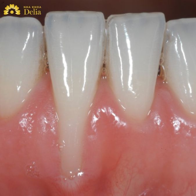 Giải pháp điều trị dứt điểm tình trạng tụt chân răng mức độ nhẹ và nặng