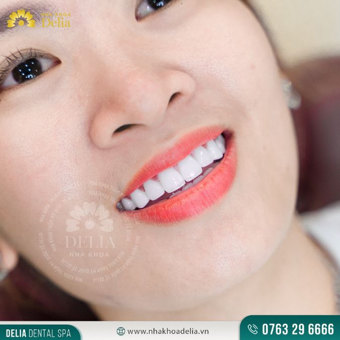 Bị mẻ răng có điềm gì? Cách khắc phục mẻ răng tốt nhất