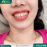 hăm khám nha khoa định kỳ từ 3 - 6 tháng/ lần để đảm bảo sức khỏe răng miệng luôn luôn tốt