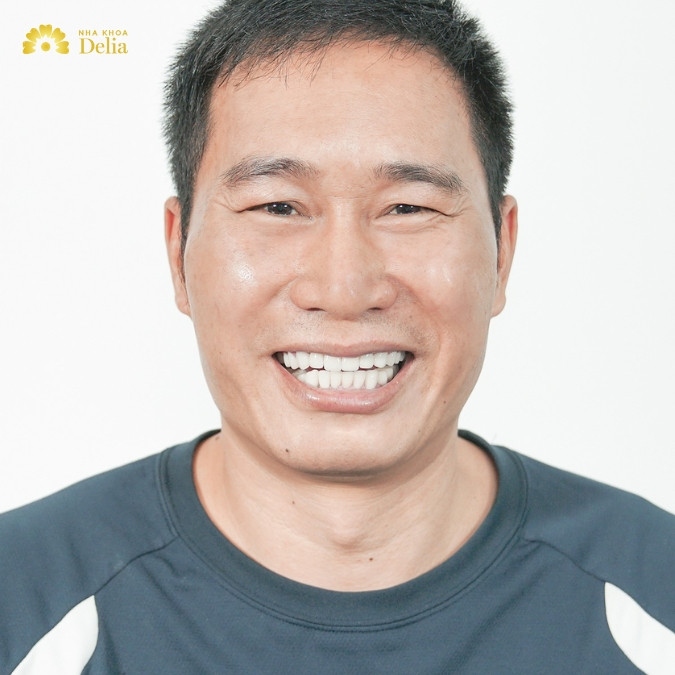 Chú Lê Xuân Hùng trồng 7 trụ Implant tại nha khoa Delia