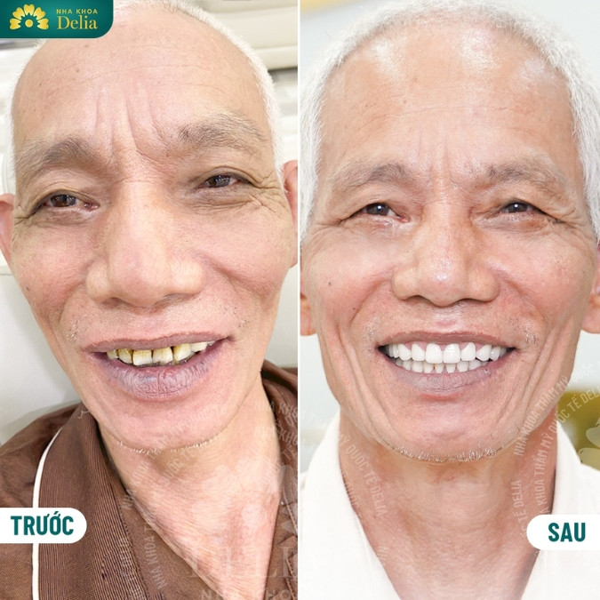 Chú Nguyễn Văn Năm chia sẻ trồng 9 trụ Implant tại nha khoa Delia