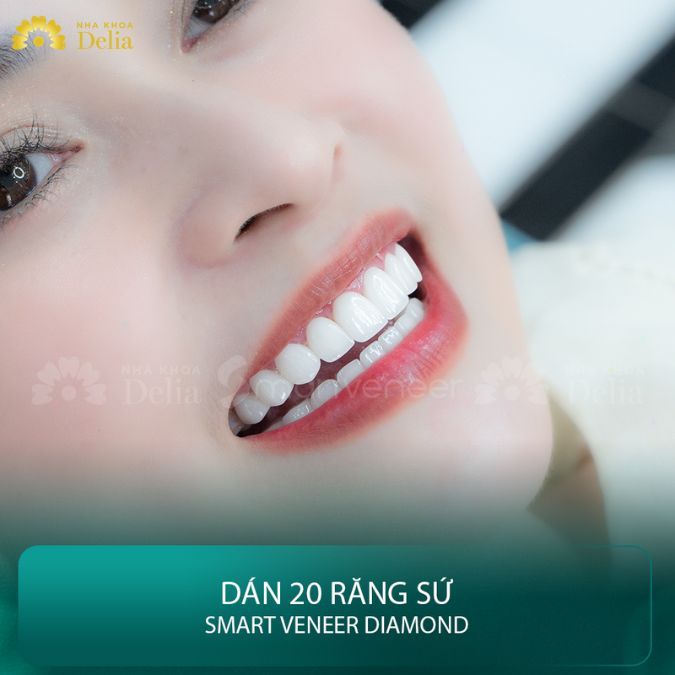 Đánh giá chi tiết: Dán sứ Veneer Diamond có tốt như lời đồn?