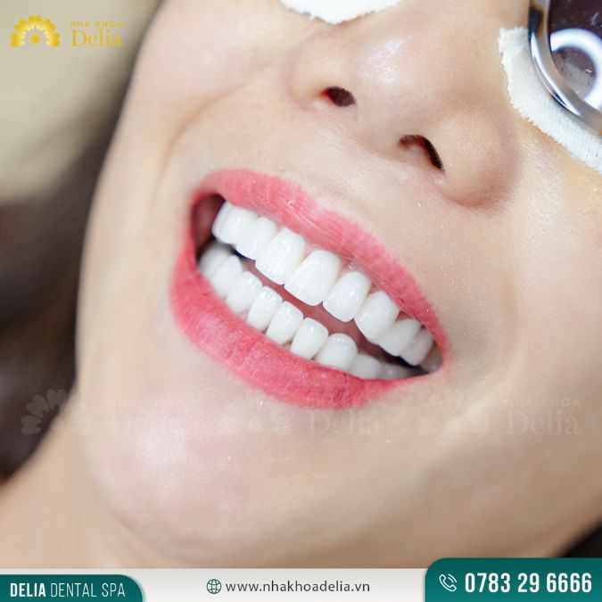 Nên hay không nên dán sứ Veneer răng thỏ? Giá cả như thế nào?