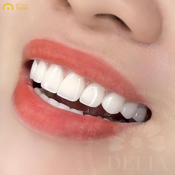 Dán sứ Veneer TPHCM ở đâu tốt? Bật mí 5 địa chỉ uy tín nhất