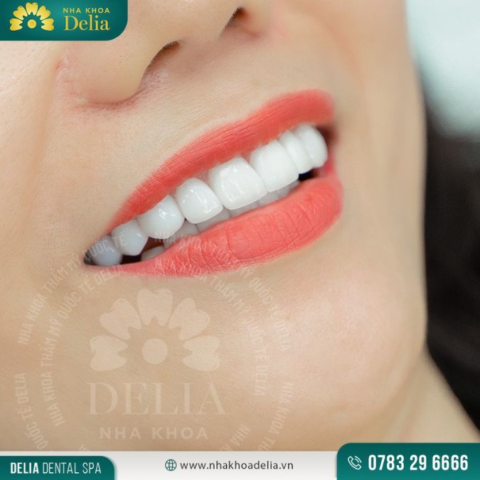 Khi nào nên dán sứ Veneer Ultrathin? Giá Ultrathin đắt hay rẻ?