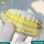 Veneer Ultrathin cải thiện hình thể của răng