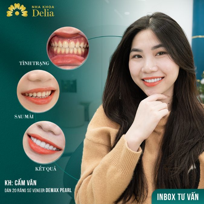 Liệu có thể dán Veneer răng thưa hay không? Giá rẻ hay đắt?