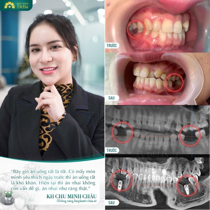 Hình ảnh trồng răng Implant thực tế của khách hàng Delia