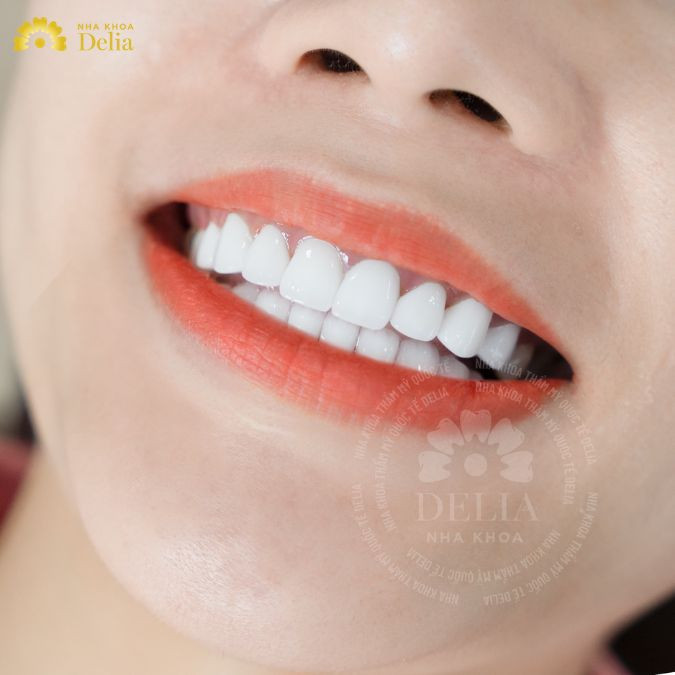How long do porcelain dental crowns last? Do dental crowns last forever?
