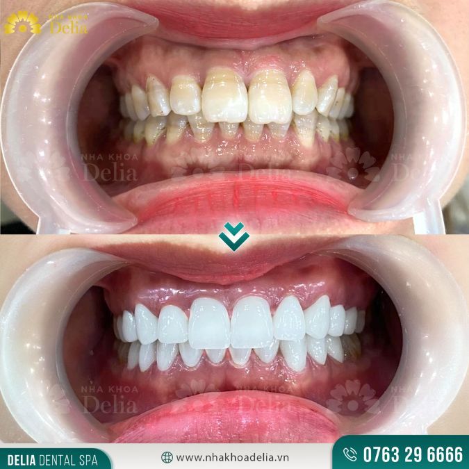 Cách cải thiện kẽ răng bị ố vàng chỉ trong 1 tuần