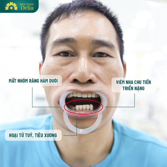 Mất răng bao lâu thì bị tiêu xương hàm? Biến chứng tiêu xương