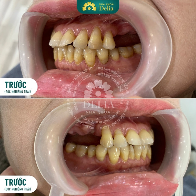 Mất răng nhai có thể gây ra những hậu quả nghiêm trọng gì?