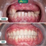 Nằm mơ thấy gãy răng nhưng không chảy máu đánh con 22 - 31