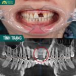 nhổ răng cửa bao lâu thì trồng lại được