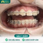 Vệ sinh răng sai cách khiến răng bị hở kẽ