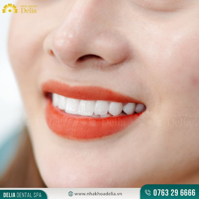 Bị mẻ răng cửa là điềm gì? Răng cửa bị mẻ phải làm sao?