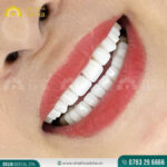 Cải thiện tình trạng răng cửa bị lệch bằng niềng răng