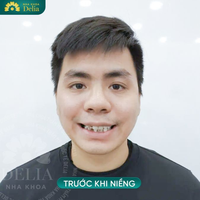 Răng hàm mọc lệch ra ngoài có nguy hiểm? Tác hại của răng hàm lệch