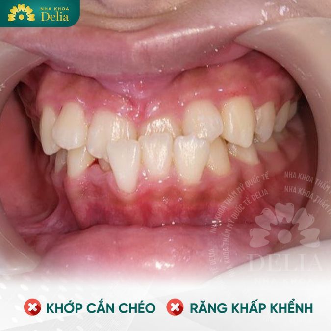 Hàm răng mọc lệch nguyên nhân do đâu? Cách điêu trị tốt nhất hiện nay là gì?