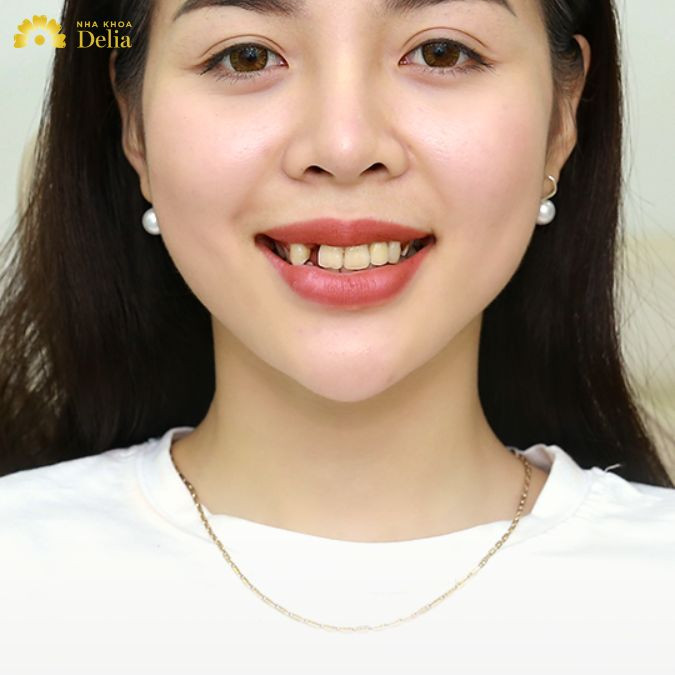 Răng khểnh đẹp hay xấu theo tướng số? Có nên niềng răng hay không?